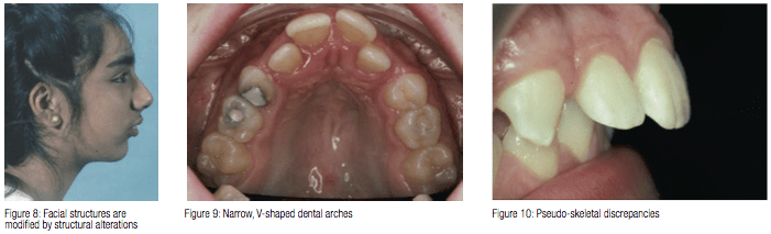 adenoid facies features