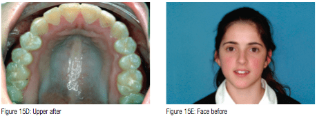 adenoid facies features