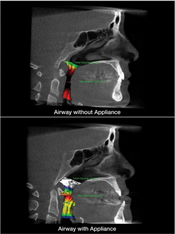 Figure 5: Airway Increase with MAD