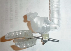 TAP-PAP™ CS with the TAP3™ as the base for the oral aspect of the device. Post attached to the TAP mechanism and nasal pillows attached to the post. CPAP hose is then attached to the nasal pillows via the collet. 