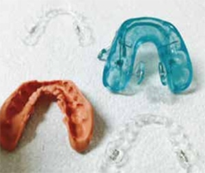 The upper Invisalign aligner is used as the upper component of the OASYS.