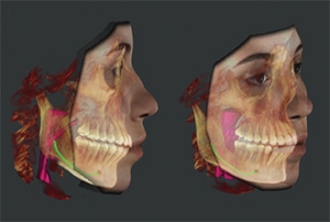 Airway analysis with Dolphin 3D