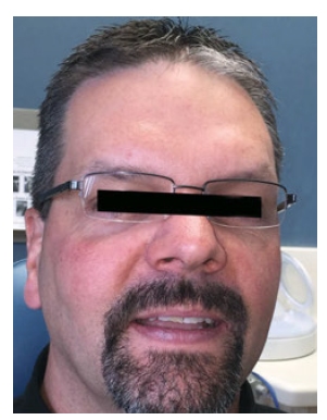 Meet JT: Diagnosed with moderate Obstructive Sleep Apnea (OSA) approximately 10 years ago and has been under my care for nearly 8 years. We have successfully managed his OSA with Mandibular Repositioning Devices (OAT); he has been well controlled with minimal adverse effects. Annual Home Sleep Tests (HST) have shown good control of OSA. Last HST was performed in 2013 and showed good results.