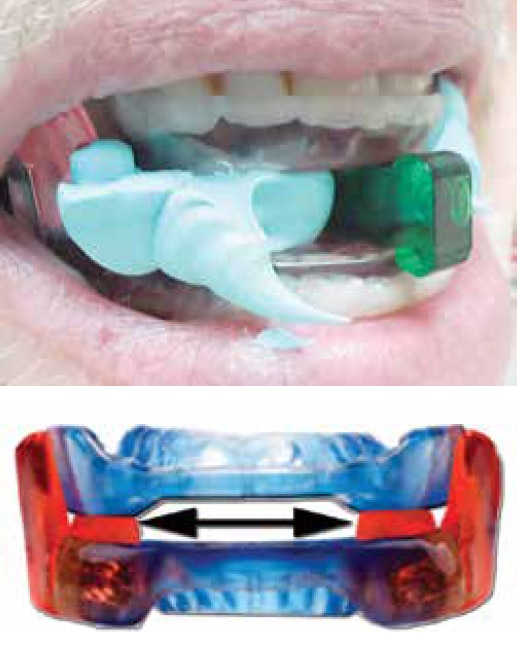 (top) Recording the modified bite: VTK separates upper & lower trays by +5mm.Bite registration paste is introduced to record the changes in VDO height (graphic illustration from different case) (bottom) Increased VDO added to Respire Blue OAT (red arrows): JT’s OAT was modified (mockup) by adding 5mm acrylic. Many OAT appliances can be modified in this manner.