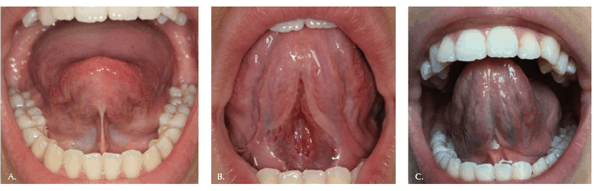 Figure 3: Photos courtesy of Paula Fabbie. (3A) 15 y.o. female; Class 3 crossbite/openbite; moderate OSA, lack of mandibular stability/ hyperlax ligaments; severely restricted lingual frenum, decreased function of tongue/hyoid complex during sleep, needs to use CPAP while waiting for DISE, and prescribed orthodontic/surgical treatment for OSA, mandibular prognathism. Pre-operative aspect of short inelastic frenum. Note limited tongue movement. (3B) Immediately following the SuperPulse CO2 laser revision. Note the clean precise incision and immediate improvement in the tongue mobility. (3C) Two weeks after SuperPulseCO2 laser frenum revision. Note lack of inflammation or swelling.