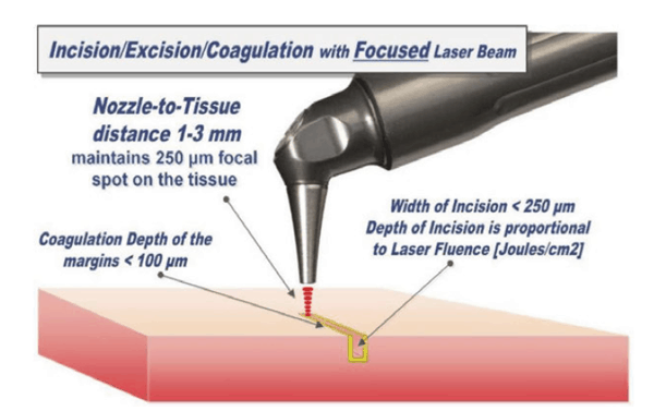 Figure 5: Laser-tissue incision with focused (0.25 mm spot size) laser beam. Defocused beam (approx. 0.8 mm spot size at 9 mm nozzle-to-tissue distance) with reduced fluence coagulates the tissue. The handpiece is pen-sized, autoclavable and uses no disposables. Graphics courtesy of LightScalpel LLC.