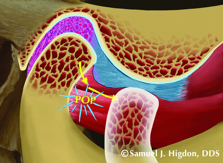 temporomandibular joint disc