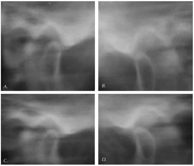 Anterior midpoint stop appliances
