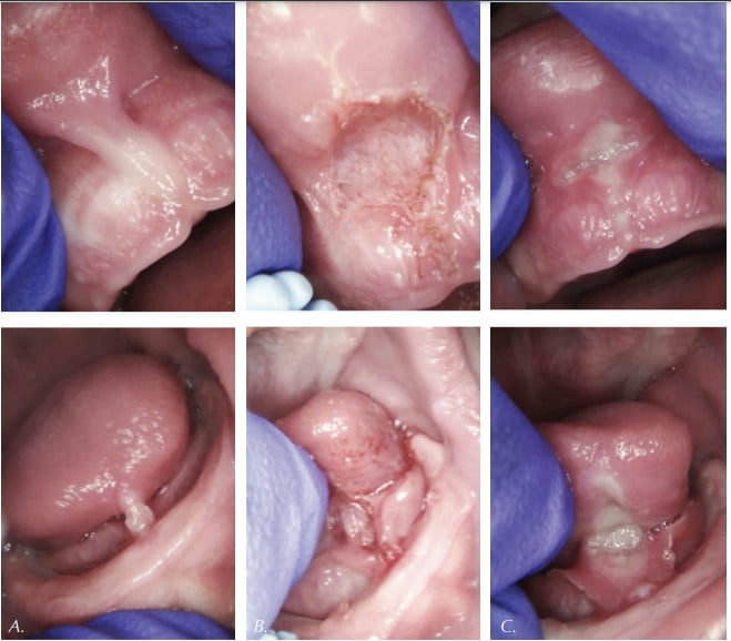 Figures 5A-5C. A: Pre-op view of restrictive lip tie (top) and tongue tie (bottom). B: Immediate post-op view of released lip tie (top) and tongue tie (bottom) with good hemostasis. C: 7 day post-op view of healed lip tie (top) and tongue tie (bottom).