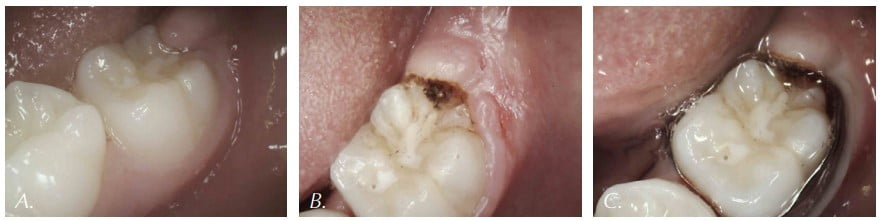 Figures 6A-6C. A: Pre-op view of operculum visible on mandibular 1st molar. The bands cannot be seated due to tissue interference. B: Immediately post-op view. Laser ablated the thick interfering tissue. Note lack of bleeding. C: Bands were seated properly and without discomfort during the same visit the operculectomy was performed.