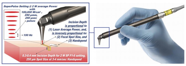Figure 1: Laser-tissue incision with focused (0.25 mm spot size) laser beam; incision depth is 0.3-0.4 mm for 2 W SP F1-6 at 3-4 mm/sec hand speed. Defocused beam (> 1-2 mm spot size) with reduced fluence does not incise, but coagulates the tissue. The handpiece is pen-sized, autoclavable and uses no disposables. LightScalpel CO2 laser angled dental tipless handpiece is pen-sized, autoclavable and uses no disposables.