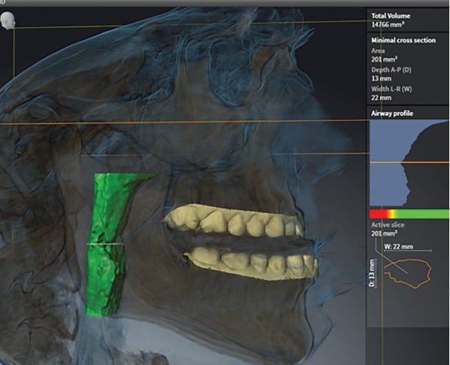 Figure 2: SICAT® Air Software with Primescan STL images inputted in preparation for ordering the OPTISLEEP oral appliance.