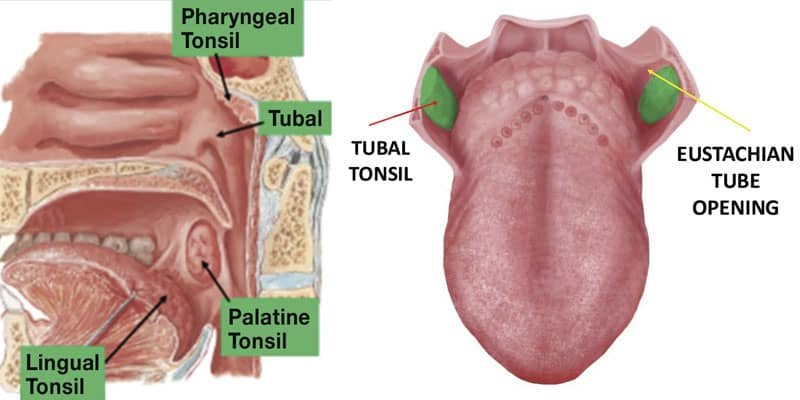 lingual tonsil stones