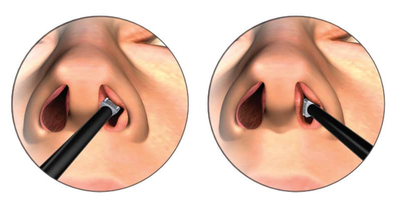 Nasal airway obstruction