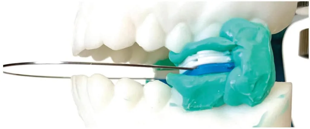 Design of oral appliance therapy