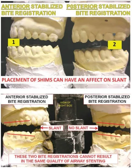Design of oral appliance therapy