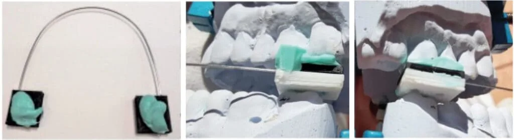 Design of oral appliance therapy