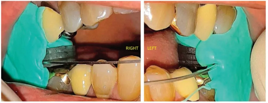 Design of oral appliance therapy