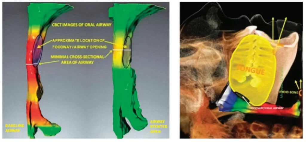 Design of oral appliance therapy