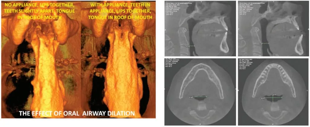 Design of oral appliance therapy