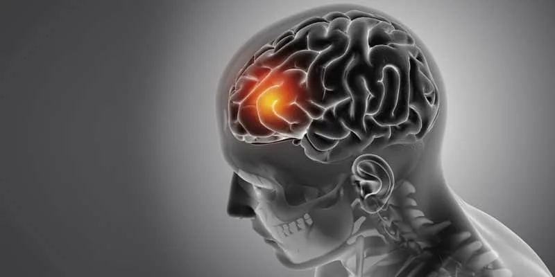 Concussion