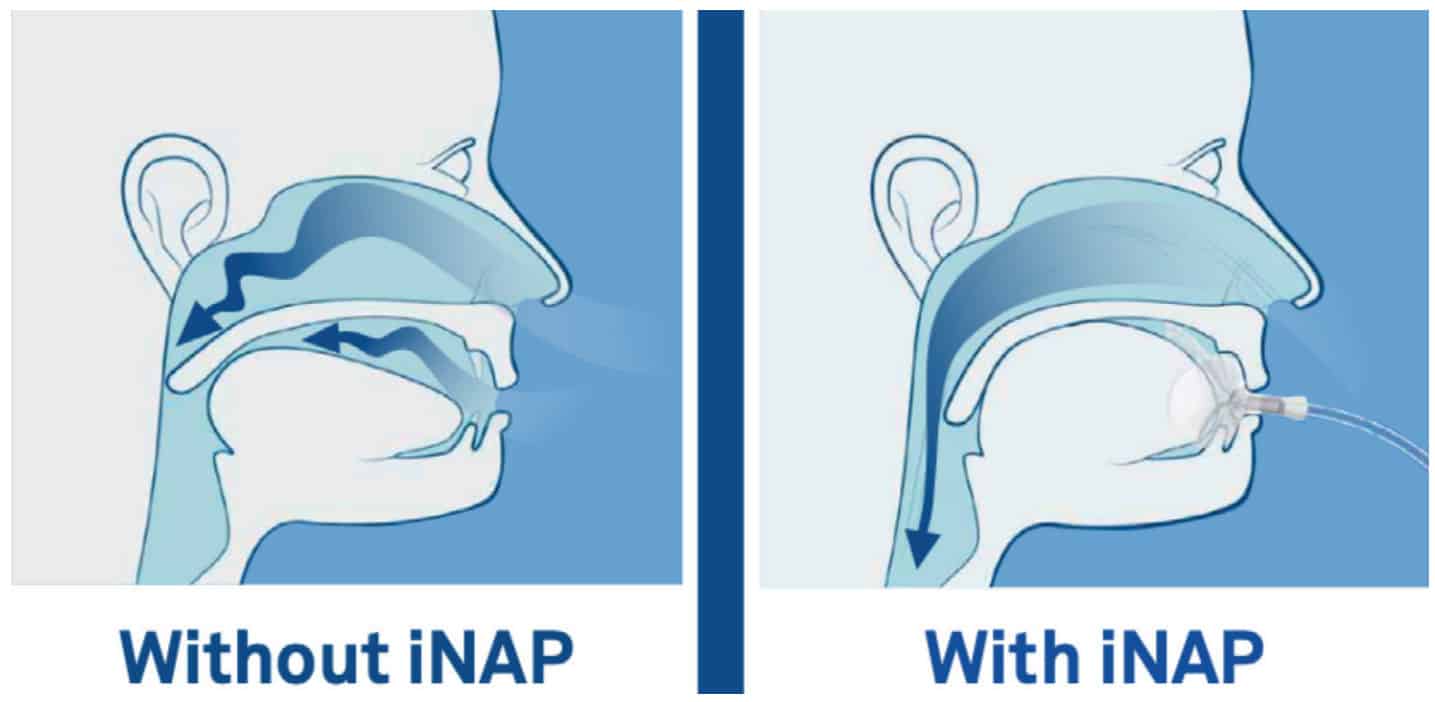 Alternative to CPAP