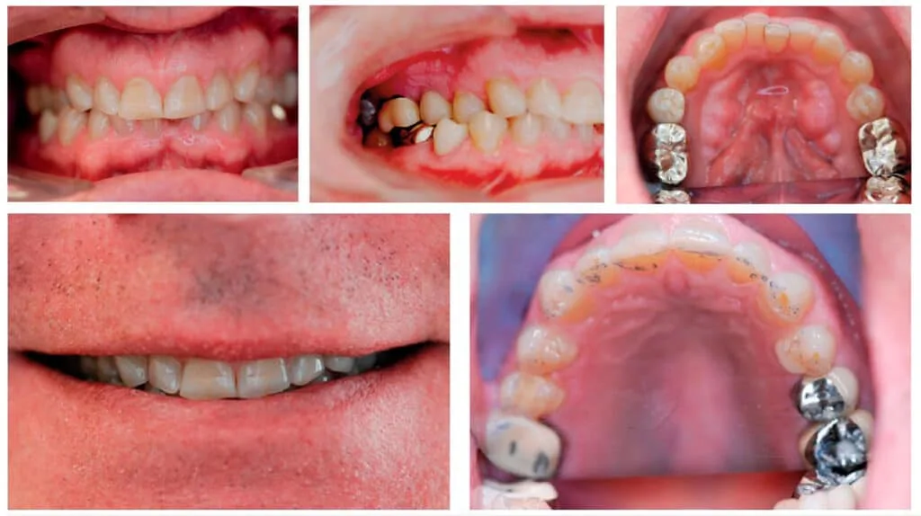 Aligner Sleep Appliance (ASA)