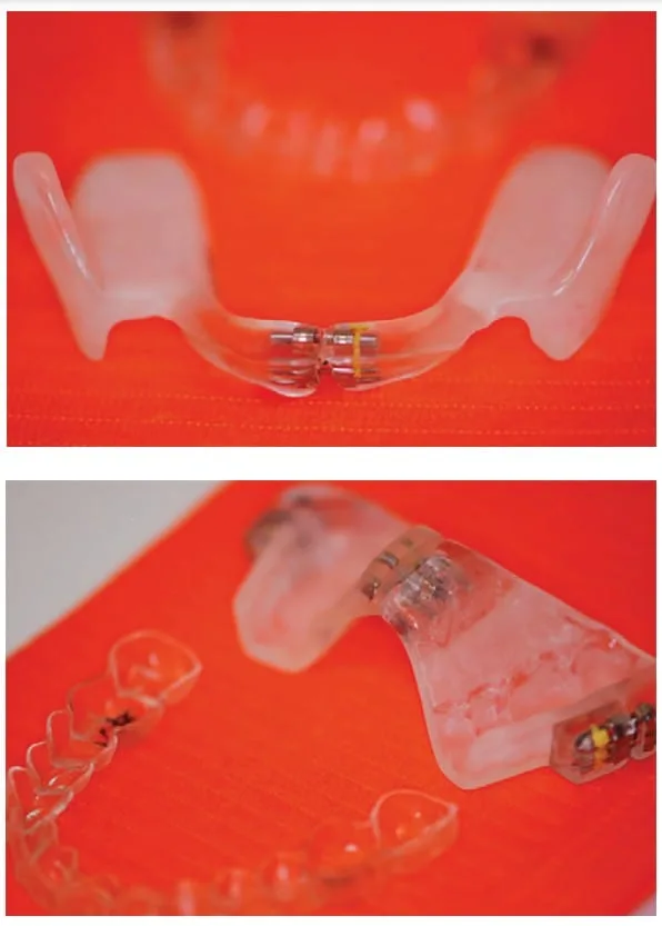 Aligner Sleep Appliance (ASA)
