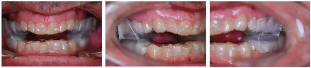 Aligner Sleep Appliance (ASA)