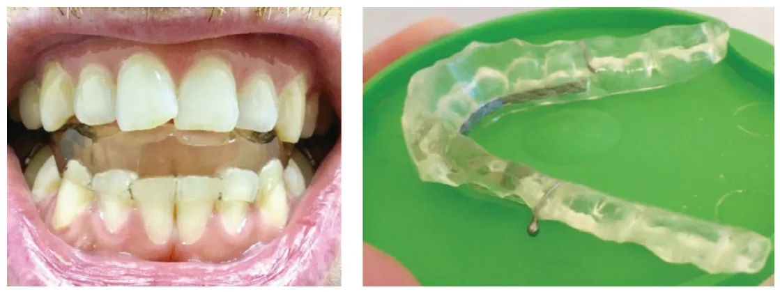 figure 3 milled orthotic splint