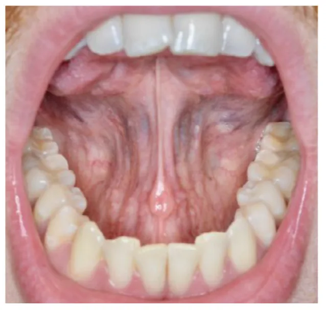 figure 6 no room for his tongue