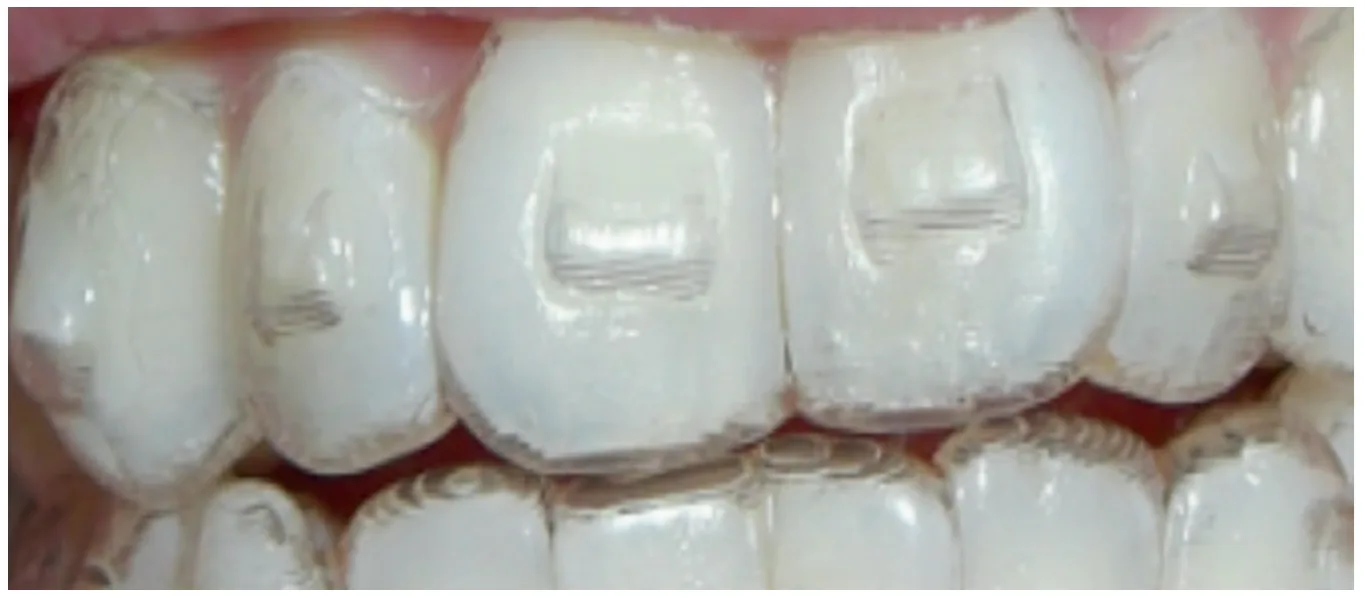 invisible retainer wedges