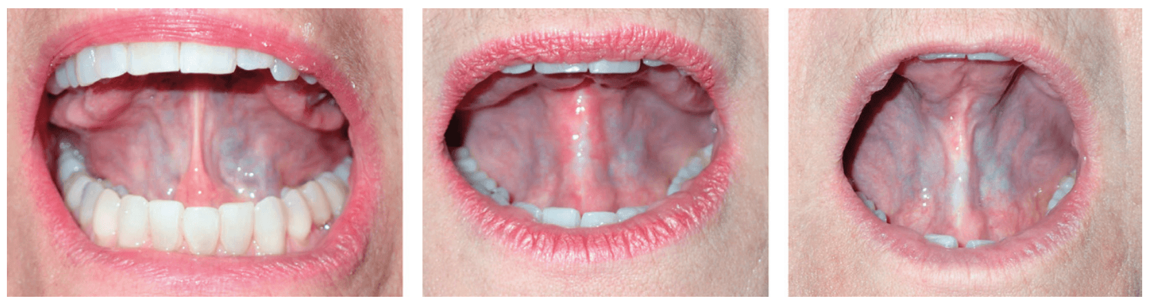 patient tongue mobility