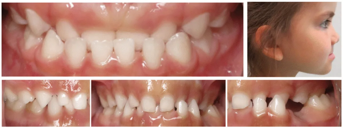 figure 3 crossbite (c in c.h.i.c.a.g.o. h.e.a.r.t.s.)