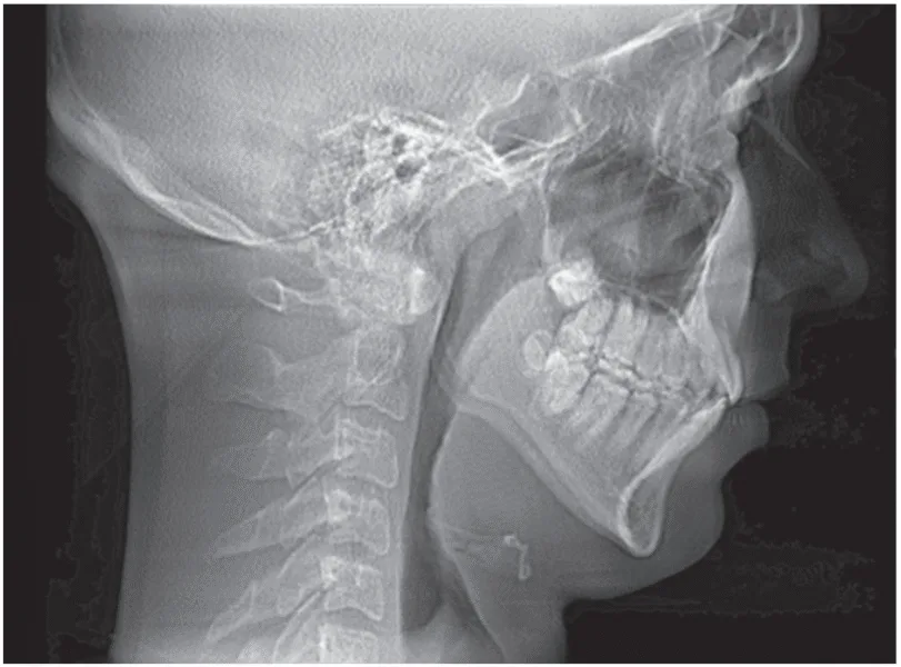 figure 4 hyper divergent facial pattern (h in c.h.i.c.a.g.o. h.e.a.r.t.s.)