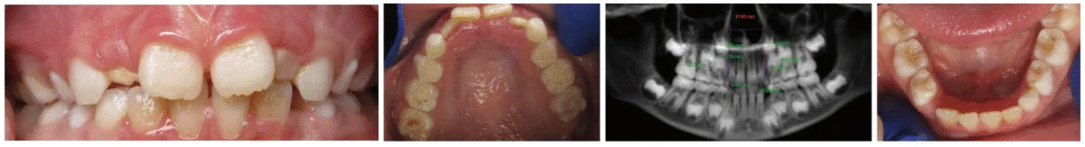 figure 5 constricted arches (second c in c.h.i.c.a.g.o. h.e.a.r.t.s.)
